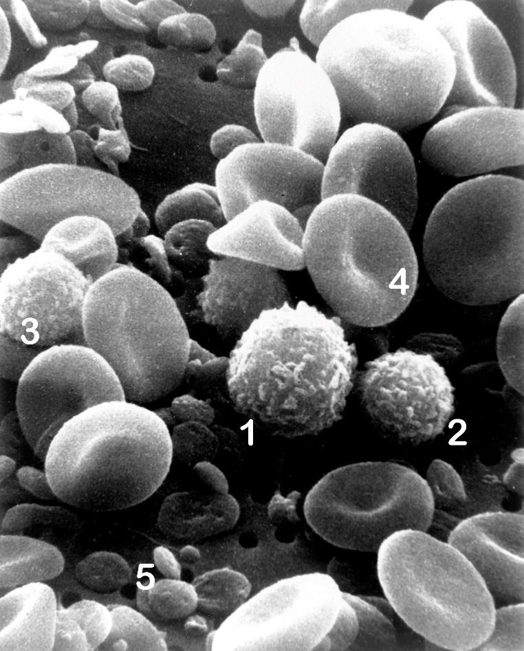 Imagem de microscopia eletrônica de células sanguíneas de uma pessoa normal, onde é possível observar eritrócitos e leucócitos, além de plaquetas. (1) Monócitos; (2) Linfócitos; (3) Neutrófilos; (4) Eritrócitos; (5) Plaquetas.