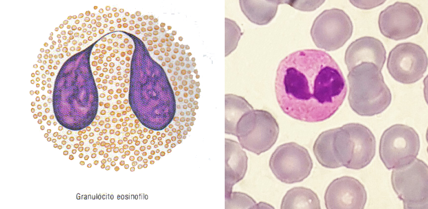 Esquema de um eosinófilo, ou acidófilo (esquerda), e como ele pode ser observado na microscopia óptica (direita). A coloração vermelha é pela presença de grânulos acidófilos.
