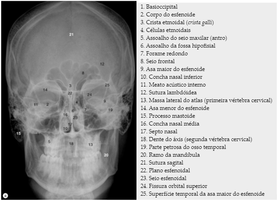 Mandíbula - Vista Medial  Anatomia dos ossos, Anatomia cabeça e pescoço,  Crânio anatomia