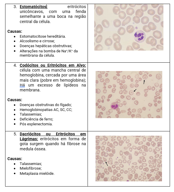 O Que é Mielofibrose? Saiba Mais sobre a Fibrose da Medula Óssea